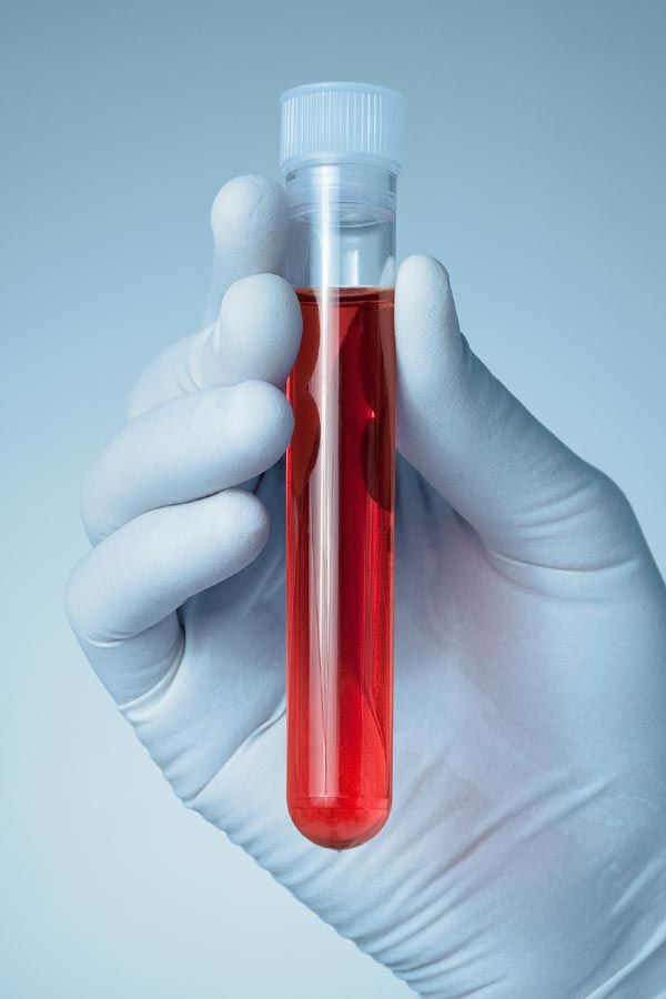Close up of a gloved hand holding a vial of red liquid, representing Morgan Burns, APRN's comprehensive autoimmune disorder treatment in New Smyrna Beach.