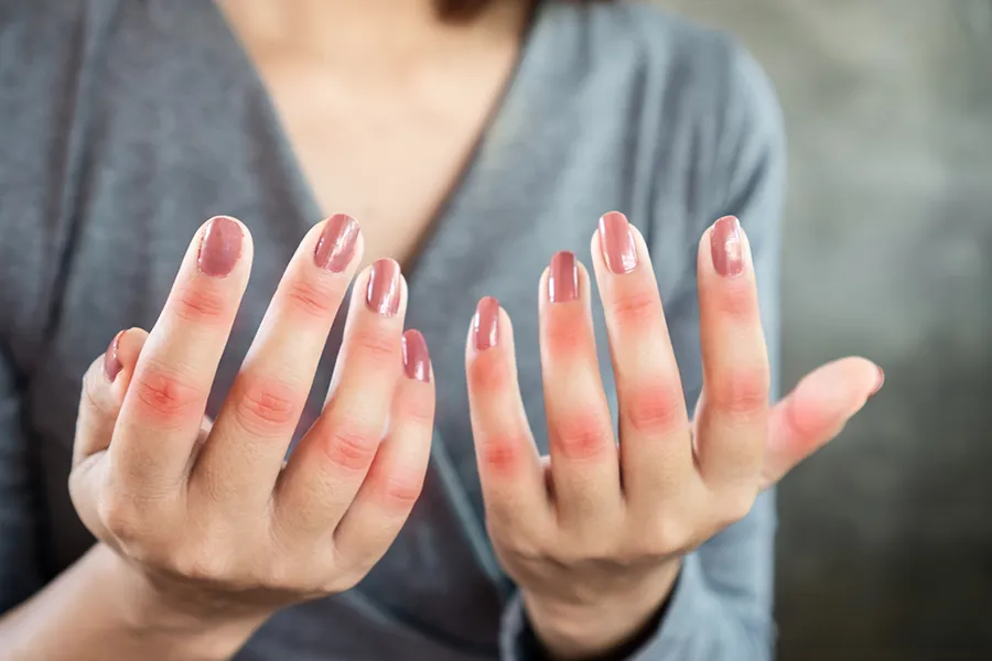 Close-up of the hands of a woman in a gray shirt, with swollen, red knuckles. Get treatment for Lupus from Morgan Burns, APRN in New Smyrna Beach.