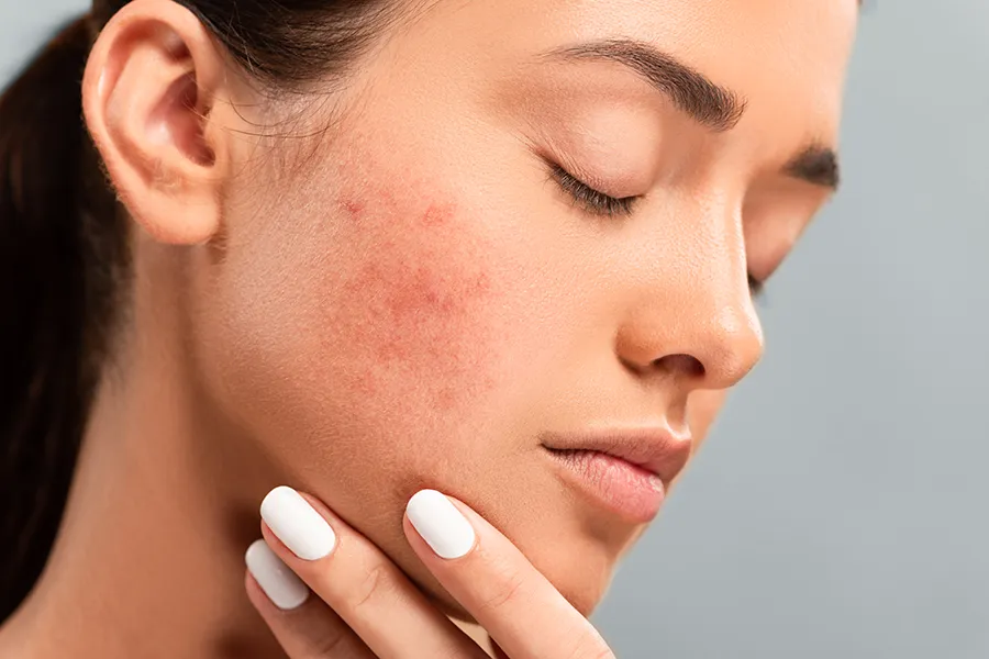Side profile of a woman touching her irritated cheek with visible acne, representing the personalized acne solutions available by Brandi Terra, NP at Oak & Stone Wellness in San Diego.