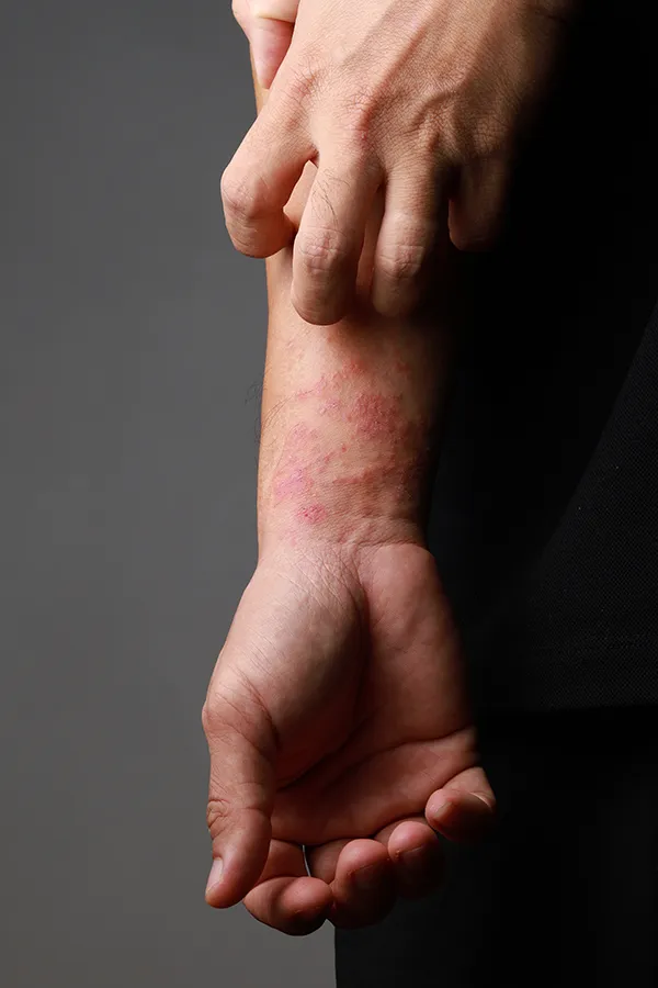 One hand scratches an area irritated by eczema on the other wrist. Get treatment for eczema from Brandi Terra, NP at Oak & Stone Wellness in San Diego.