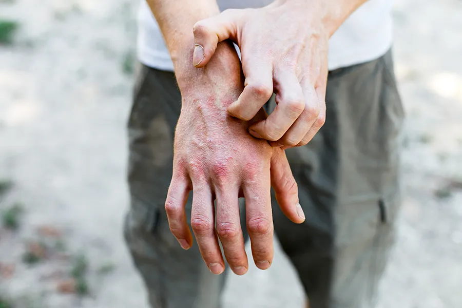 Close-up of a man scratching his hands while experiencing Psoriasis. Get care for Psoriasis from Brandi Terra, NP at Oak & Stone Wellness in San Diego.