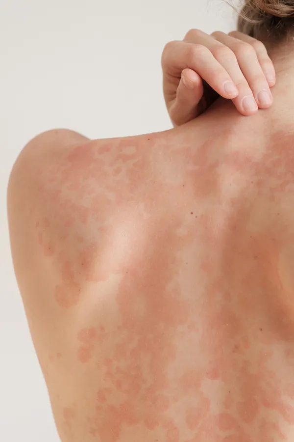 The back and shoulder of a woman experiencing Psoriasis. Get treatment for Psoriasis from Brandi Terra, NP at Oak & Stone Wellness in San Diego.